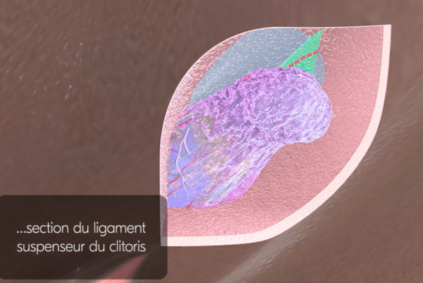 chirurgie réparatrice du clitoris après une excision